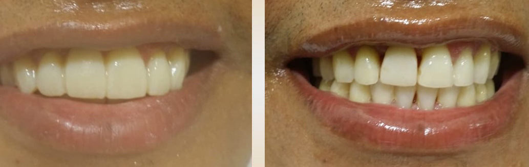 lucas-antesedepois-estetica